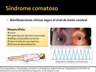 Semiología Medica , Fisiopatología, Semiotecnia y Propedéutica, Argentes Alvares- Fisiopatología de Carol Porth 46
Revista de las Ciencias de la Salud de Cienfuegos Vol. 11, No. Especial 1 2006
 Manifestaciones clínicas según el nivel de lesión cerebral
Mesencéfalo:
Coma
Pupilas fijas de diámetro intermedio.
Reflejo oculocefalico anormal.
Hiperventilación neurogenica.
Postura de descerebración.
 