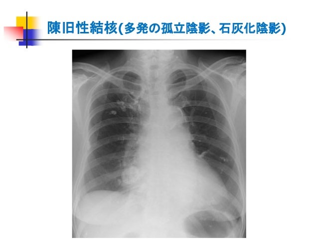 Pm34 胸部ｘ線写真の読影