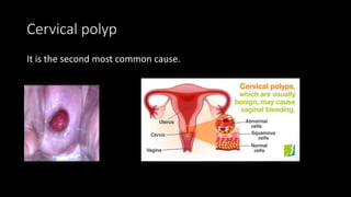 Cervical polyp
It is the second most common cause.
 
