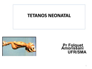 TETANOS NEONATAL
Pr Folquet
Amorissani
UFR/SMA
1
 