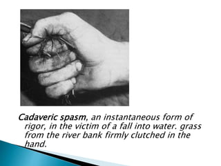Cadaveric spasm, an instantaneous form of
rigor, in the victim of a fall into water. grass
from the river bank firmly clutched in the
hand.
 
