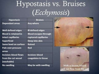  Incise the suspected area
◦ Intravascular  hypostasis
◦ Infiltrating surrounding tissue outside vessel 
contusion
◦ Send for HPE for confirmation
 