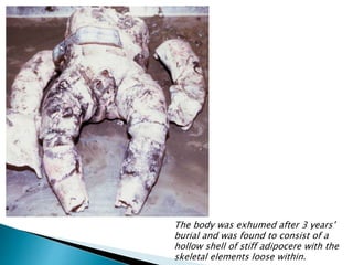 The body was exhumed after 3 years’
burial and was found to consist of a
hollow shell of stiff adipocere with the
skeletal elements loose within.
 