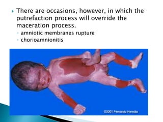  There are occasions, however, in which the
putrefaction process will override the
maceration process.
◦ amniotic membranes rupture
◦ chorioamnionitis
 
