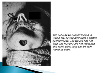 The old lady was found locked in
with a cat, having died from a gastric
haemorrhage. The wound has not
bled, the margins are not reddened
and tooth crenations can be seen
round its edge.
 