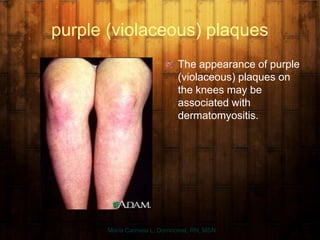 purple (violaceous) plaques
The appearance of purple
(violaceous) plaques on
the knees may be
associated with
dermatomyositis.
Maria Carmela L. Domocmat, RN, MSN
 