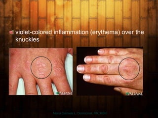 violet-colored inflammation (erythema) over the
knuckles
Maria Carmela L. Domocmat, RN, MSN
 
