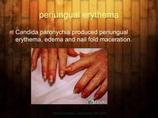 periungual erythema
Candida paronychia produced periungual
erythema, edema and nail fold maceration.
Maria Carmela L. Domocmat, RN, MSN
 