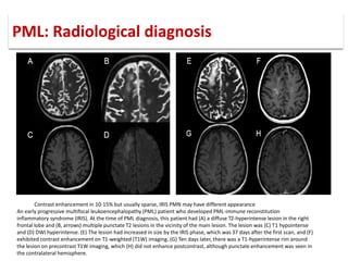 PML: Radiological diagnosis
Contrast enhancement in 10-15% but usually sparse, IRIS PMN may have different appearance
An early progressive multifocal leukoencephalopathy (PML) patient who developed PML-immune reconstitution
inflammatory syndrome (IRIS). At the time of PML diagnosis, this patient had (A) a diffuse T2-hyperintense lesion in the right
frontal lobe and (B, arrows) multiple punctate T2 lesions in the vicinity of the main lesion. The lesion was (C) T1 hypointense
and (D) DWI hyperintense. (E) The lesion had increased in size by the IRIS phase, which was 37 days after the first scan, and (F)
exhibited contrast enhancement on T1-weighted (T1W) imaging. (G) Ten days later, there was a T1-hyperintense rim around
the lesion on precontrast T1W imaging, which (H) did not enhance postcontrast, although punctate enhancement was seen in
the contralateral hemisphere.
 