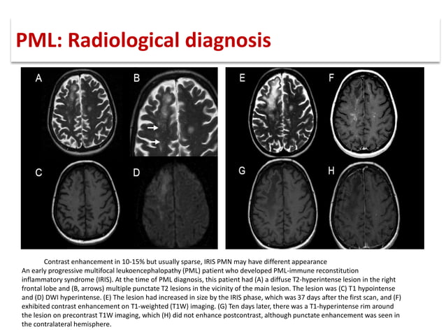 Progressive multifocal leukoencephalopathy (PML) | PDF