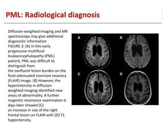 PML: Radiological diagnosis
Diffusion-weighted imaging and MR
spectroscopy may give additional
diagnositic information
FIGURE 3: (A) In this early
progressive multifocal
leukoencephalopathy (PML)
patient, PML was difficult to
distinguish from
the confluent lesion burden on the
fluid-attenuated inversion recovery
(FLAIR) image. (B) However, the
hyperintensity in diffusion-
weighted imaging identified new
areas of abnormality. A further
magnetic resonance examination 6
days later showed (C)
an increase in size of the right
frontal lesion on FLAIR with (D) T1
hypointensity.
 