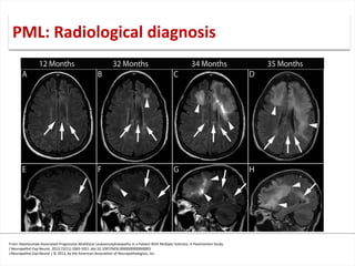 From: Natalizumab-Associated Progressive Multifocal Leukoencephalopathy in a Patient With Multiple Sclerosis: A Postmortem Study
J Neuropathol Exp Neurol. 2013;72(11):1043-1051. doi:10.1097/NEN.0000000000000005
J Neuropathol Exp Neurol | © 2013, by the American Association of Neuropathologists, Inc.
PML: Radiological diagnosis
 