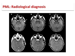 PML: Radiological diagnosis
 