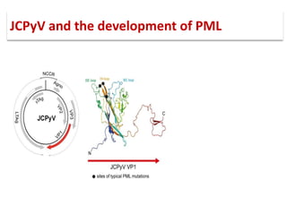 JCPyV and the development of PML
 