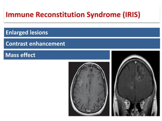 Enlarged lesions
Contrast enhancement
Mass effect
Immune Reconstitution Syndrome (IRIS)
 