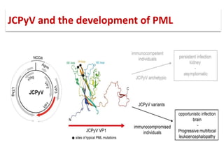 JCPyV and the development of PML
 