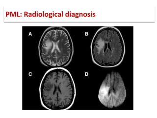 Progressive Multifocal Leukoencephalopathy Gross