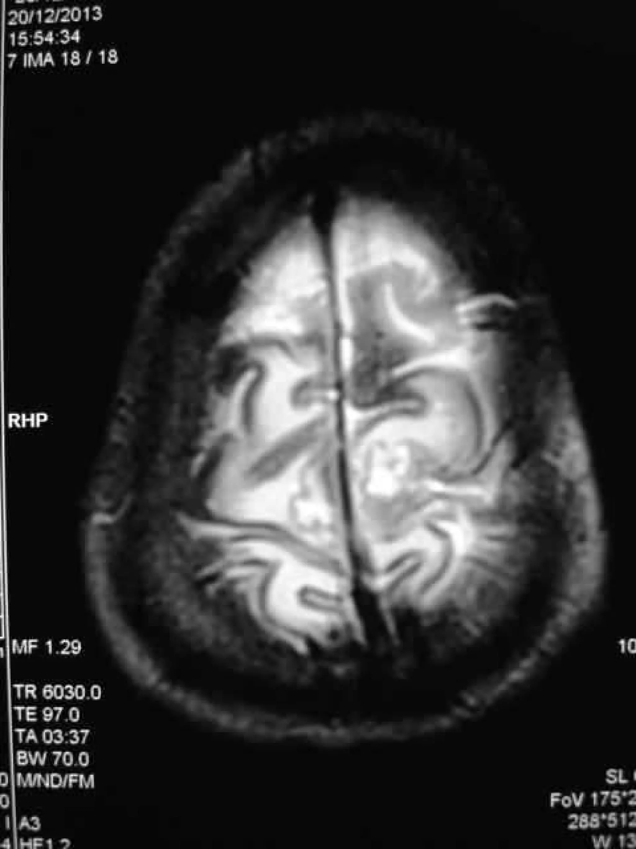 Progressive multifocal leukoencephalopathy