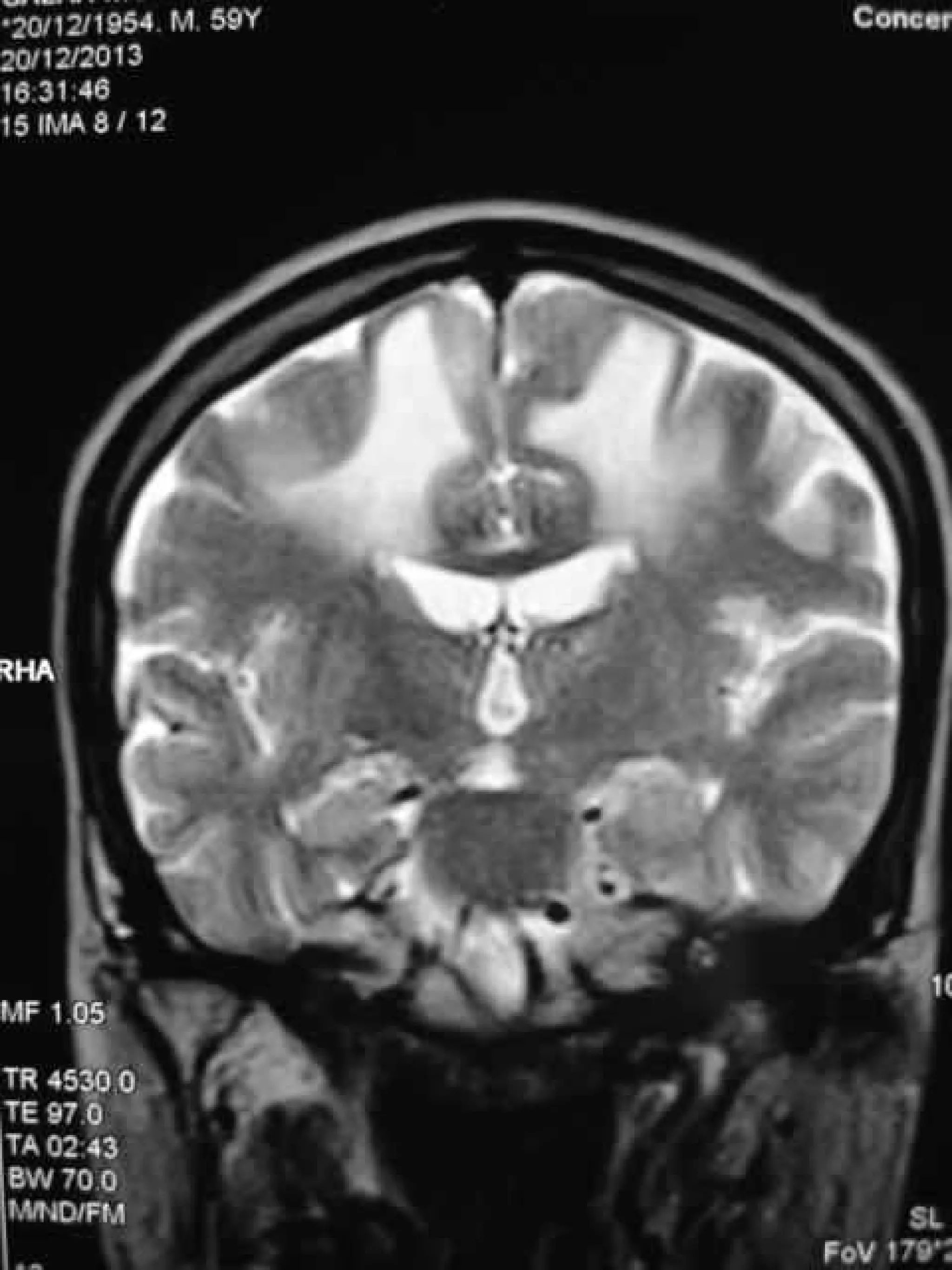 Progressive multifocal leukoencephalopathy