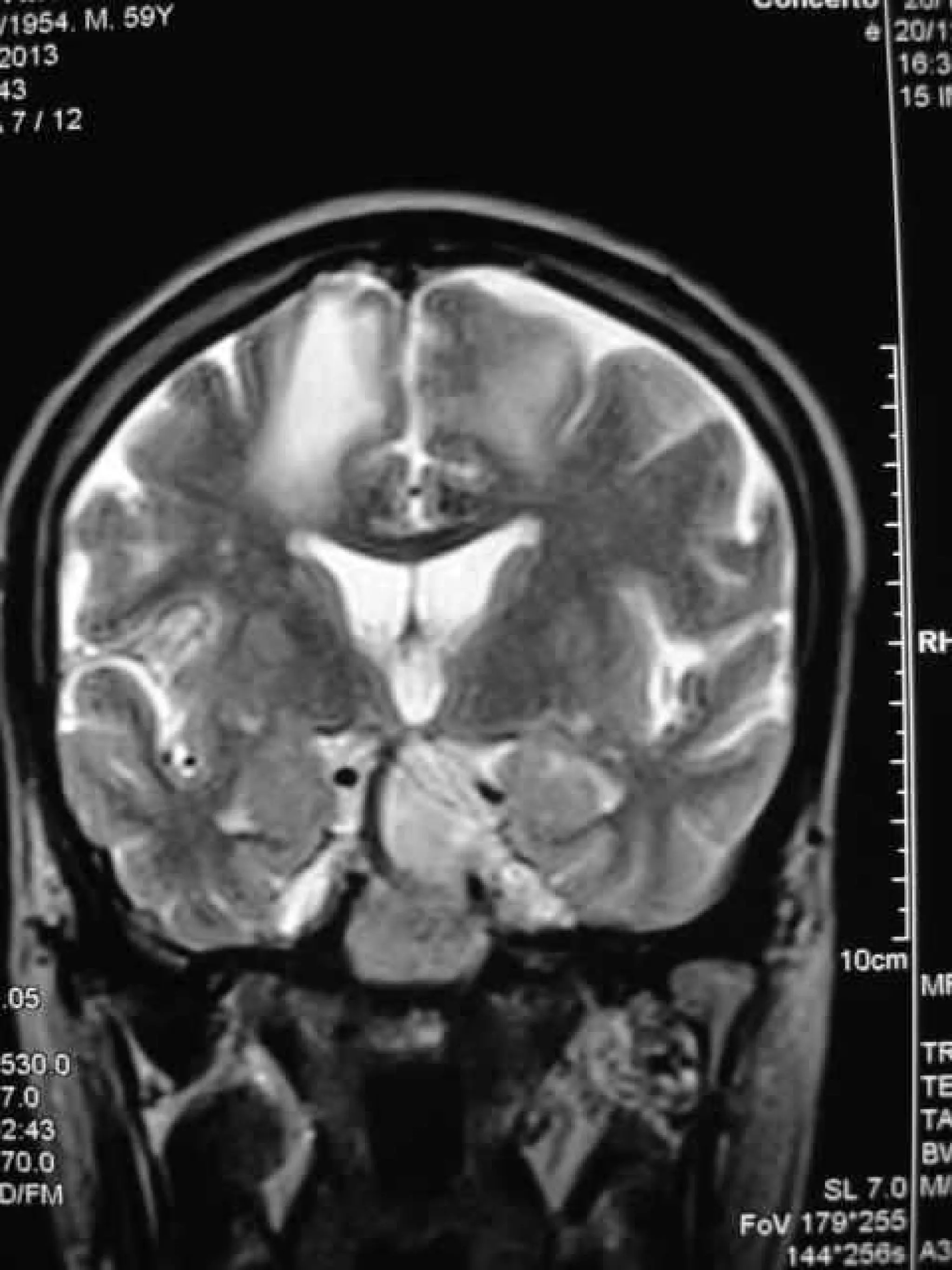 Progressive multifocal leukoencephalopathy