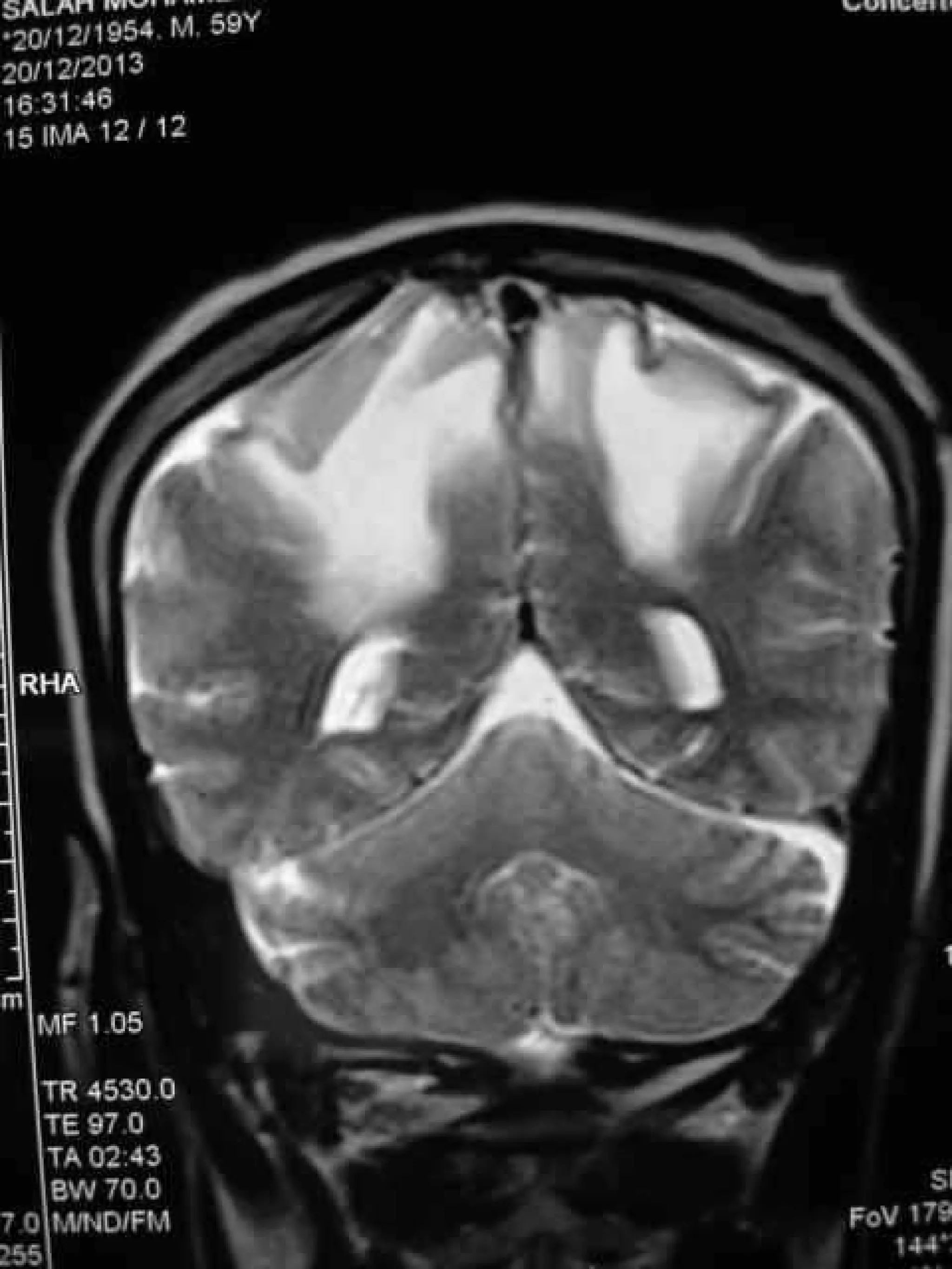 Progressive multifocal leukoencephalopathy