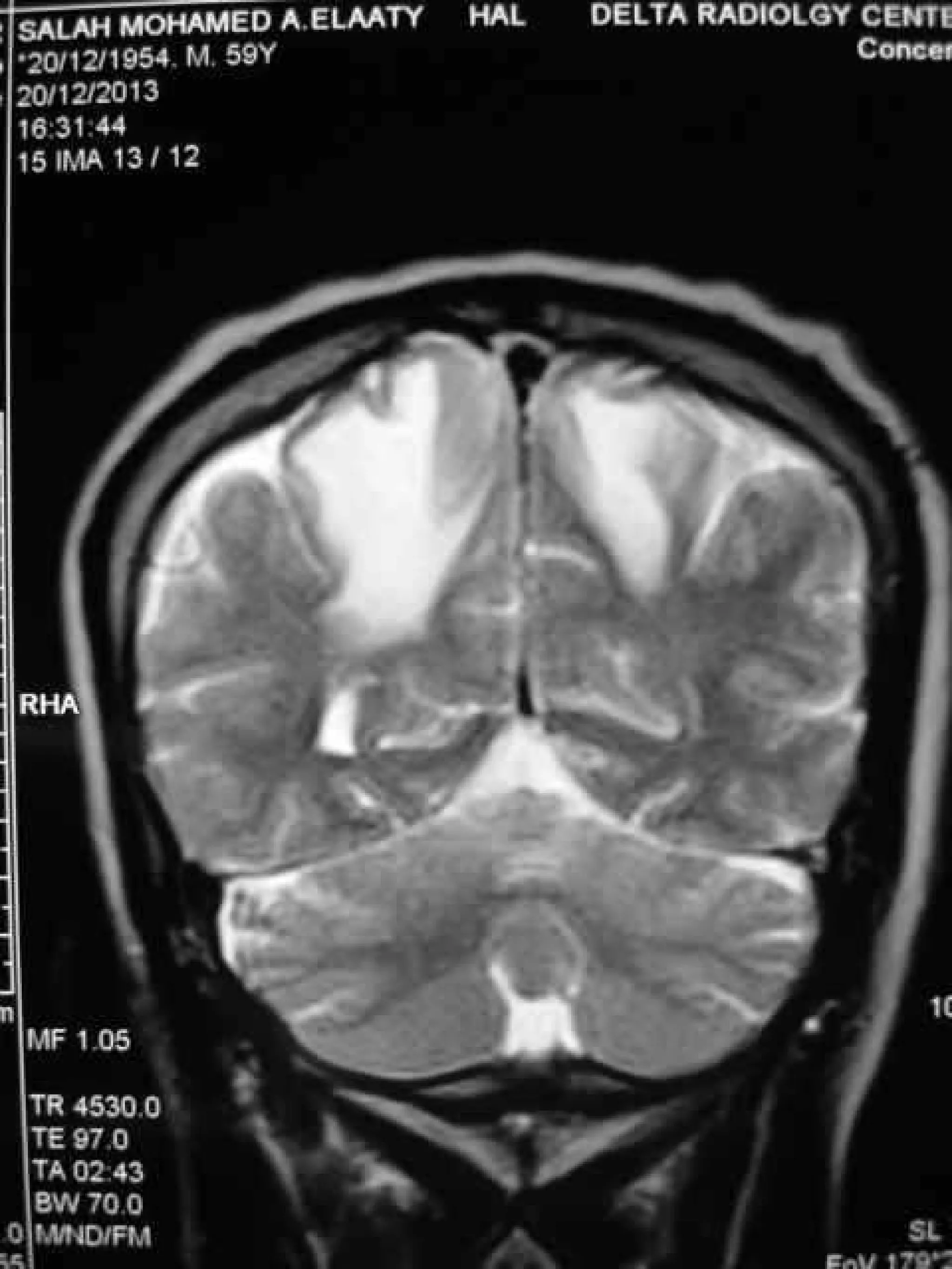 Progressive multifocal leukoencephalopathy