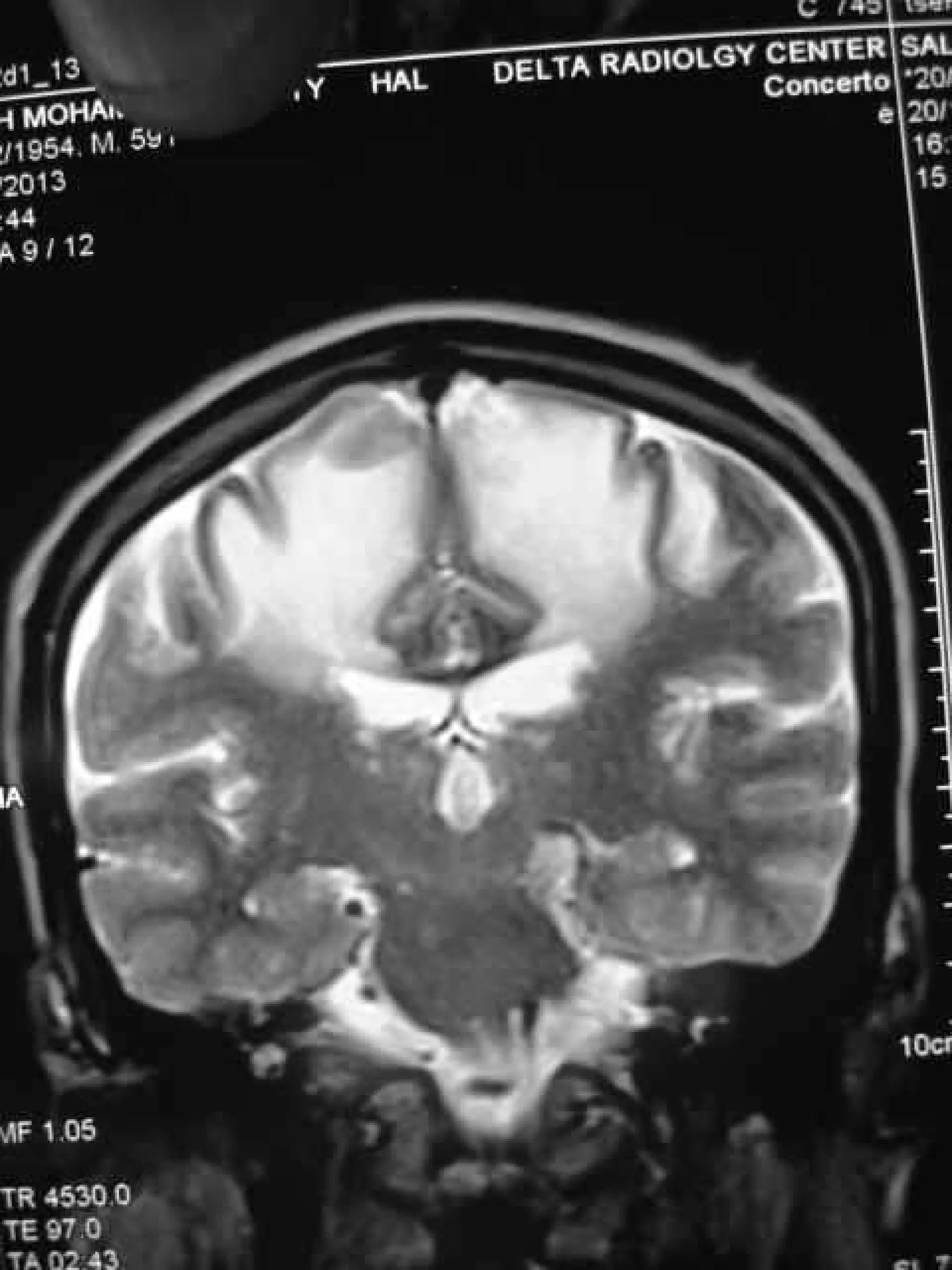 Progressive multifocal leukoencephalopathy