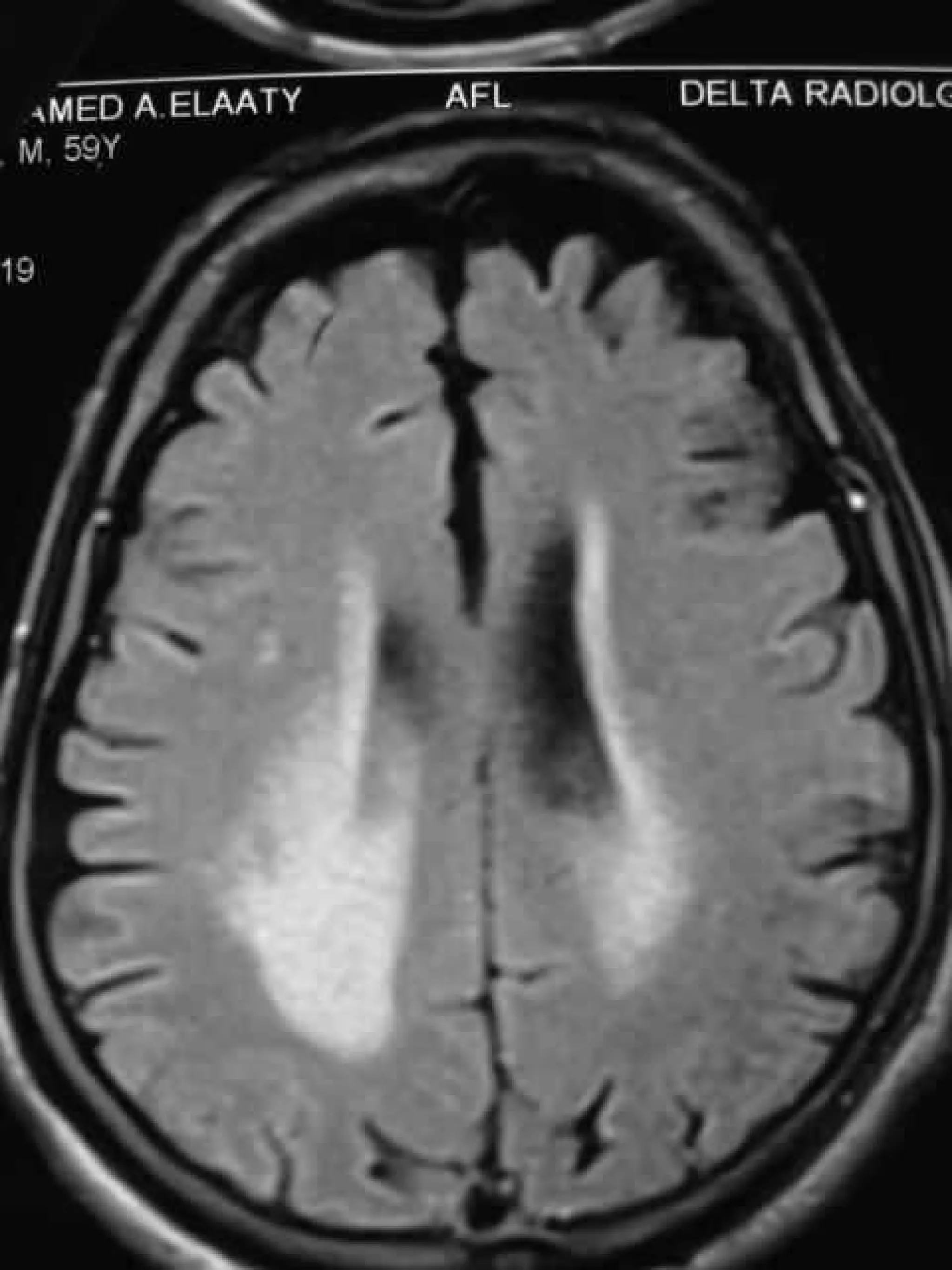 Progressive multifocal leukoencephalopathy