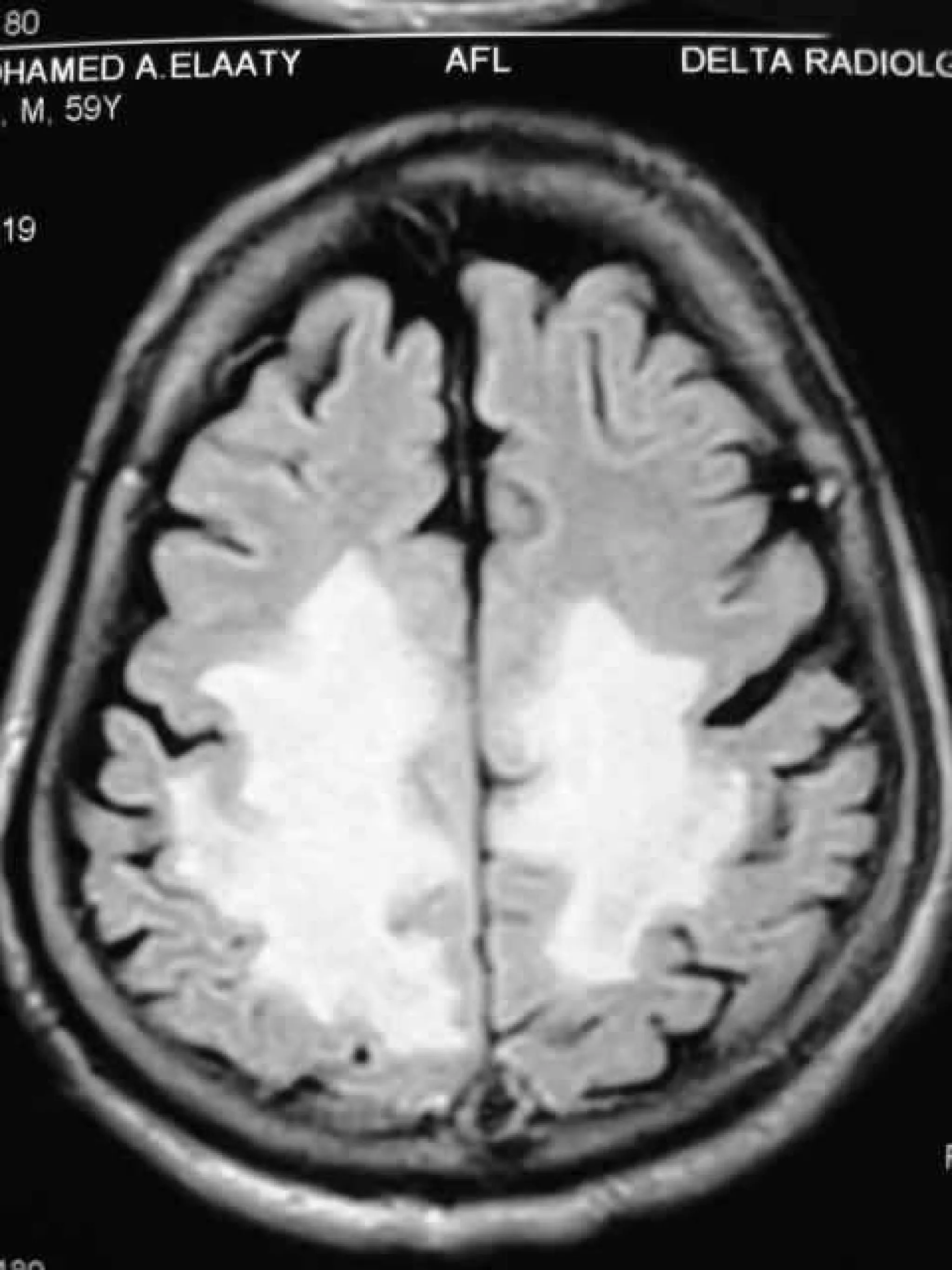 Progressive multifocal leukoencephalopathy
