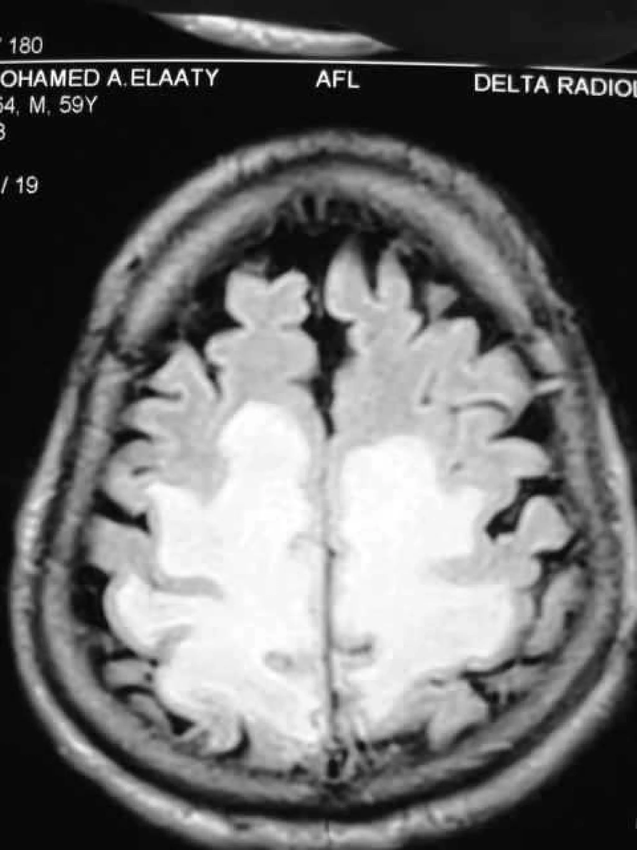 Progressive multifocal leukoencephalopathy