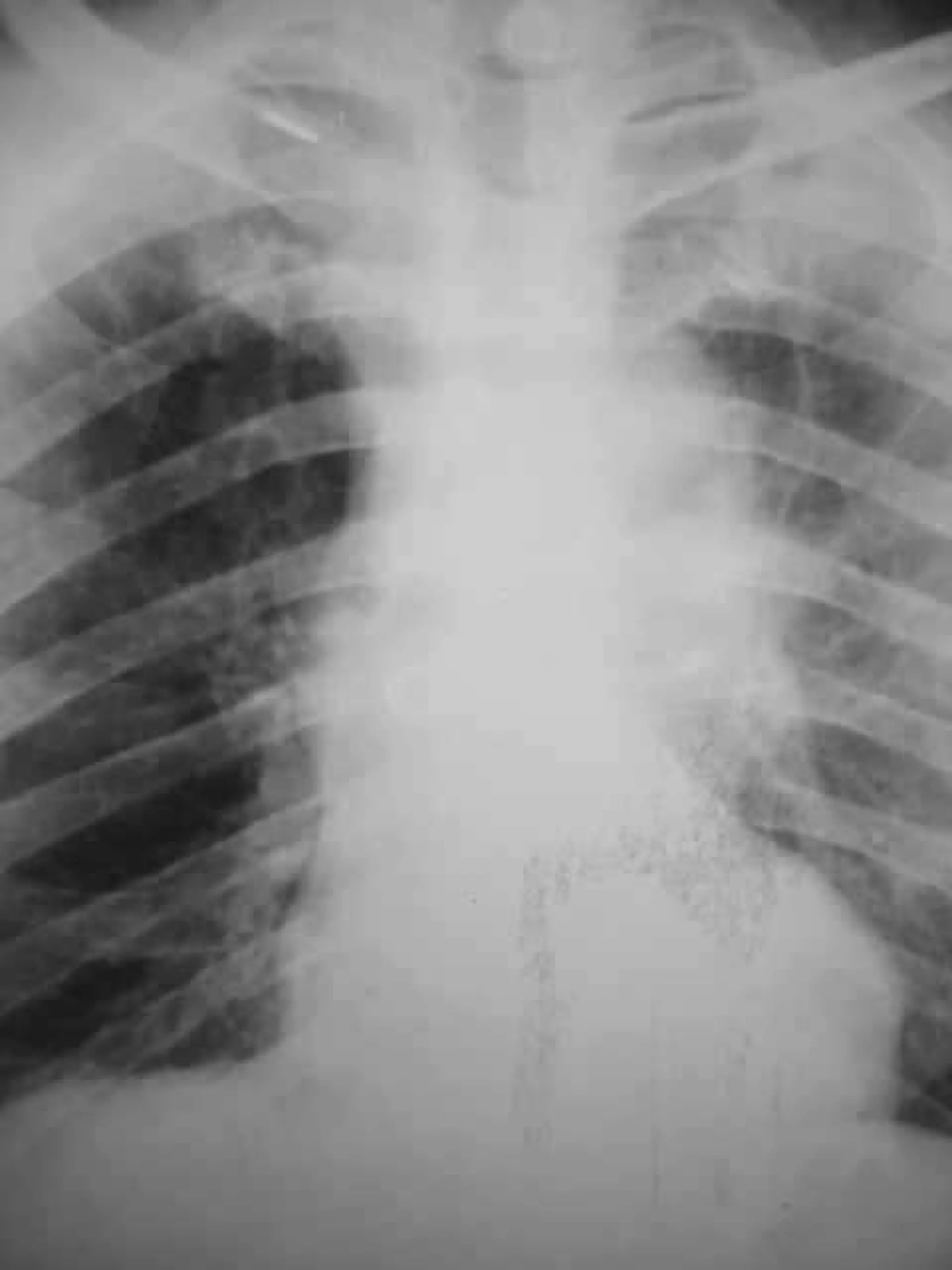 Progressive multifocal leukoencephalopathy