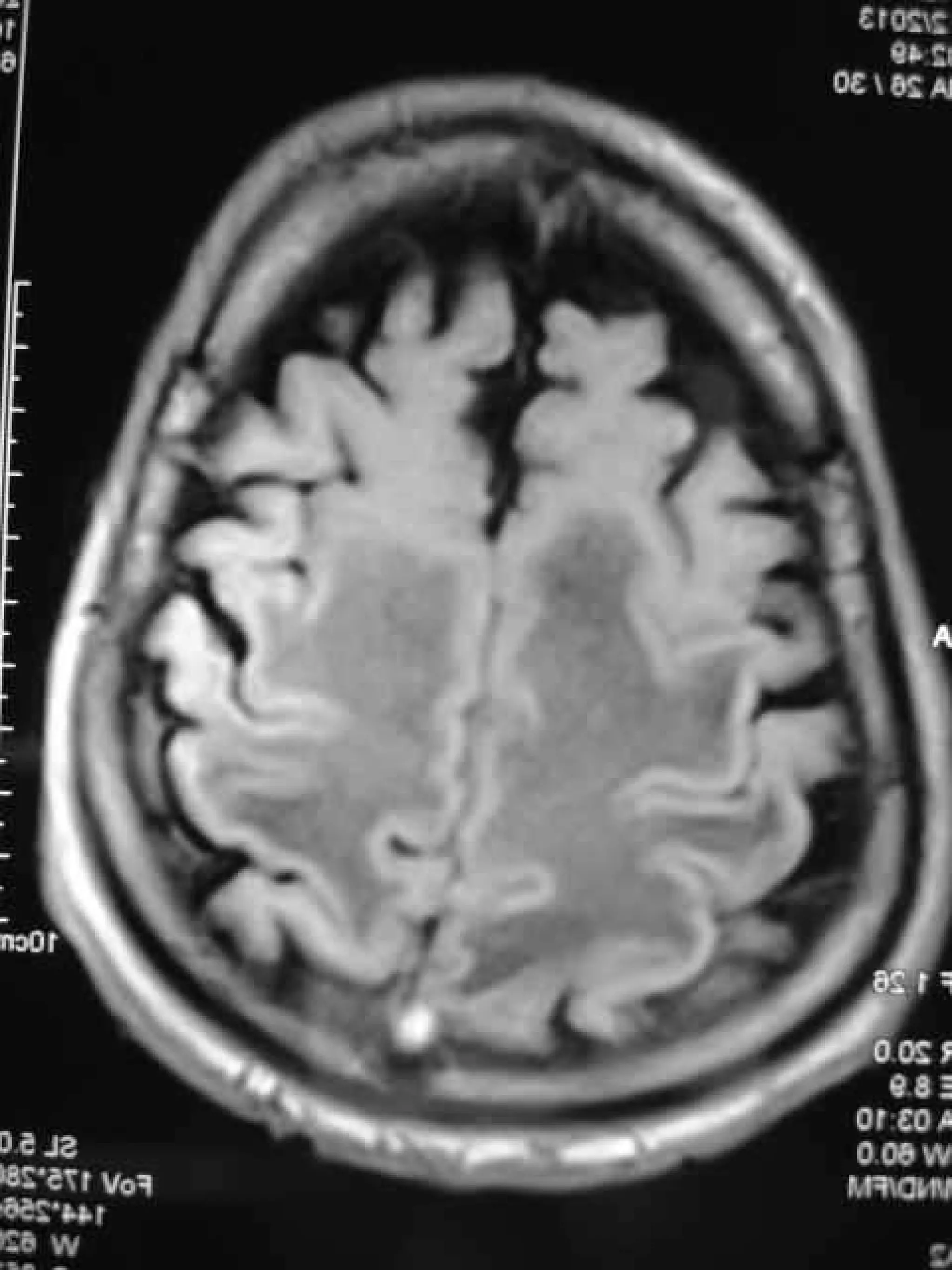 Progressive multifocal leukoencephalopathy