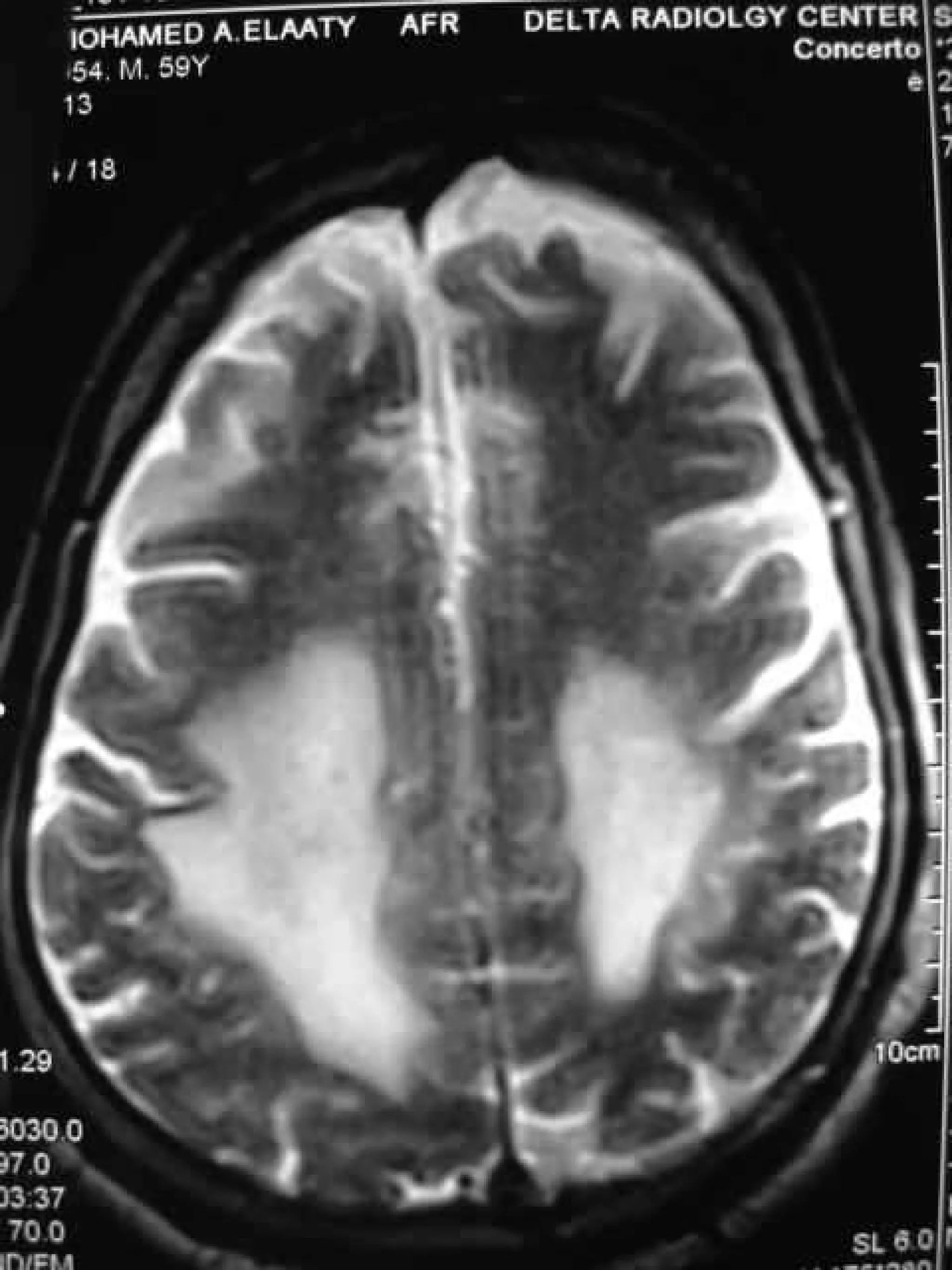 Progressive multifocal leukoencephalopathy