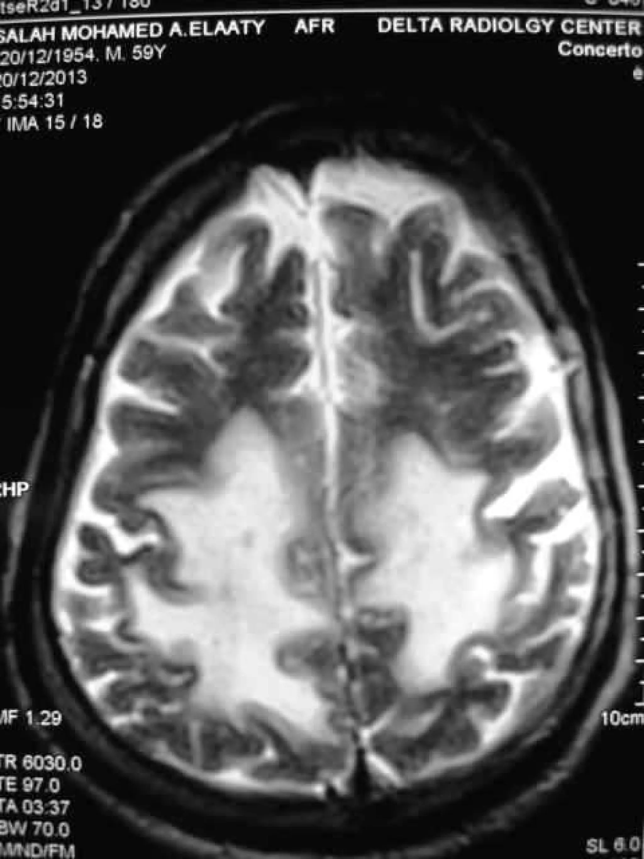 Progressive multifocal leukoencephalopathy