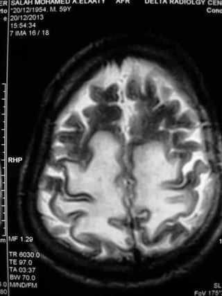 Progressive multifocal leukoencephalopathy