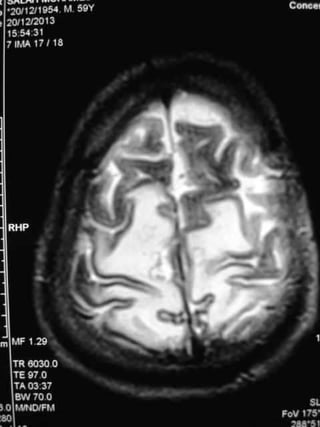 Progressive multifocal leukoencephalopathy