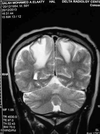 Progressive multifocal leukoencephalopathy