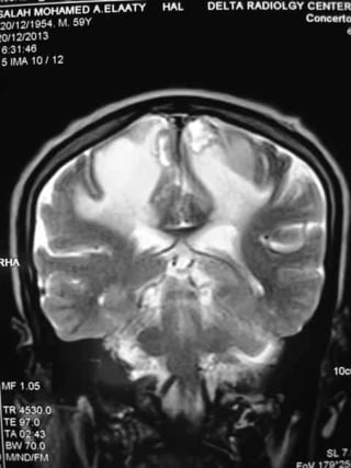 Progressive multifocal leukoencephalopathy