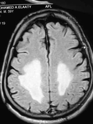 Progressive multifocal leukoencephalopathy