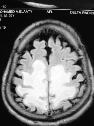 Progressive multifocal leukoencephalopathy