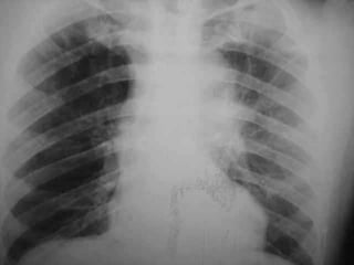 Progressive multifocal leukoencephalopathy