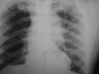 Progressive multifocal leukoencephalopathy