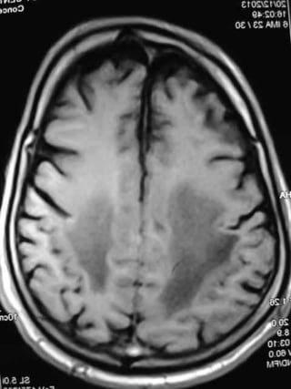 Progressive multifocal leukoencephalopathy
