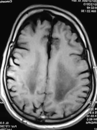 Progressive multifocal leukoencephalopathy