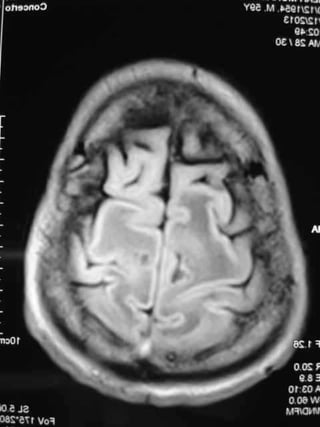 Progressive multifocal leukoencephalopathy