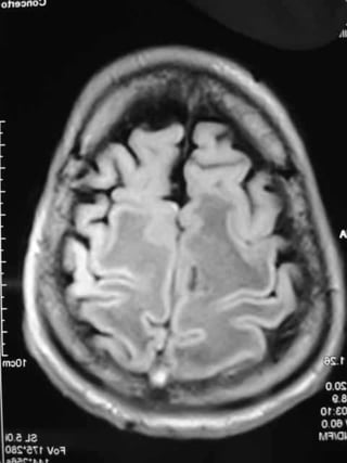 Progressive multifocal leukoencephalopathy