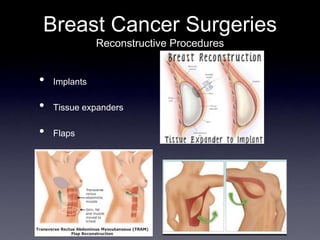 Breast Cancer Surgeries
Reconstructive Procedures
• Implants
• Tissue expanders
• Flaps
 