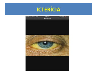 ICTERÍCIA
 