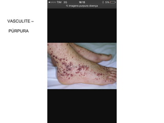 VASCULITE –
PÚRPURA
 
