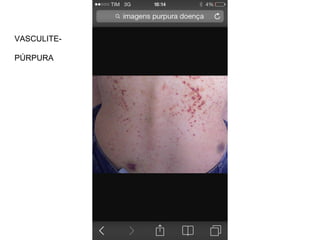 VASCULITE-
PÚRPURA
 